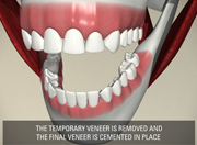 Dental Veneers - Mississauga, Meadowvale, Streetsville, Milton, Georgetown, Brampton